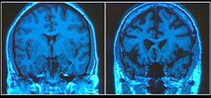 Make the right decision, help your loved one - Damaging effects of alcohol abuse on your brain 